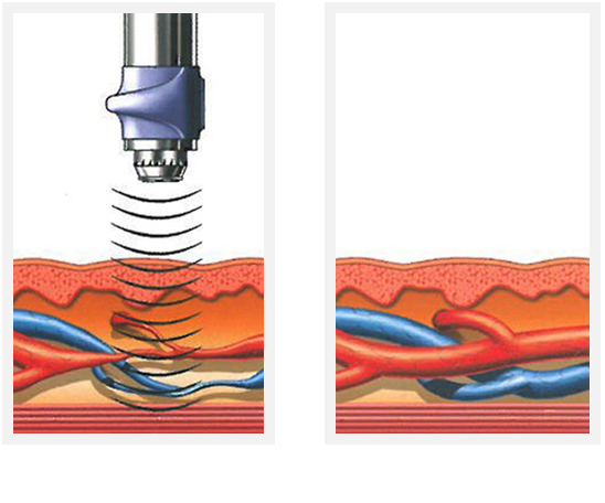 Acoustic Wave Therapy